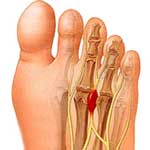 Neuroma